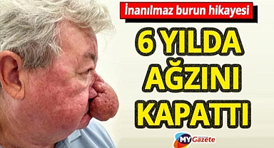 6 yılda burna ağzını kapattı! Eşini öpemeyen adamın kâbusu 4 saatlik ameliyatla sona erdi!