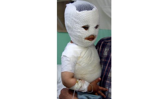 400 kişi tandır ve süt kazanına düşerek yandı