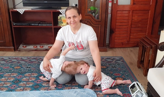 Kafadan yapışık siyam ikizleri ameliyatla bir birinden ayrıldı.